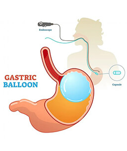 Dr.Samir Website Gastric Balloons Services Detailed