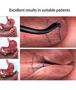 Dr.Samir Website Endoscopic Sleeve <br />
Gastroplasty Services Detailed