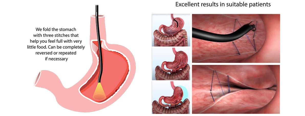 Dr.Samir Website Endoscopic Sleeve <br />
Gastroplasty Services Detailed