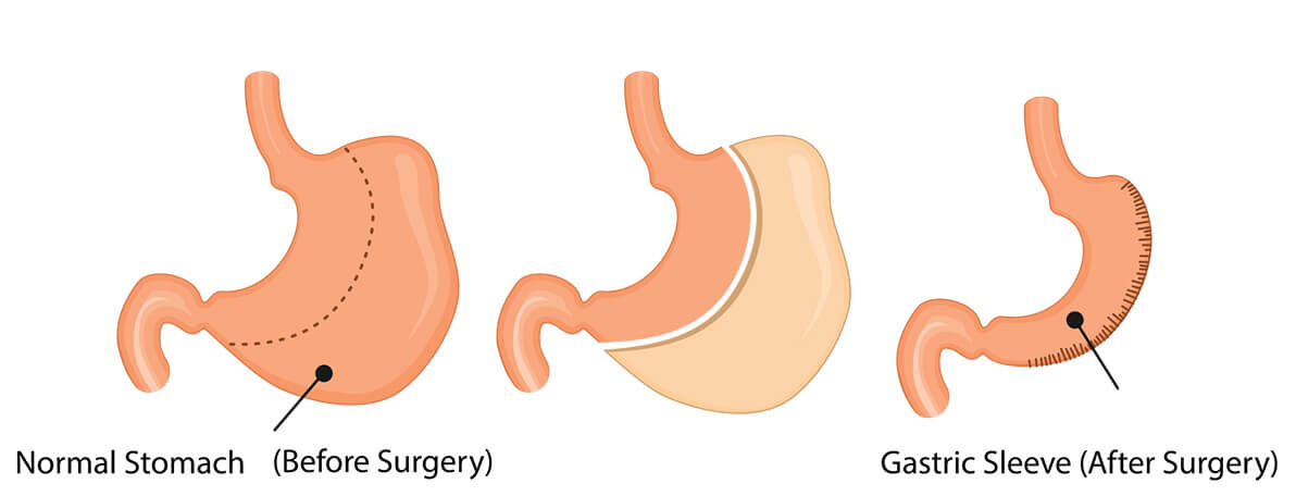 Dr.Samir Website Sleeve Gastrectomy Services Detailed