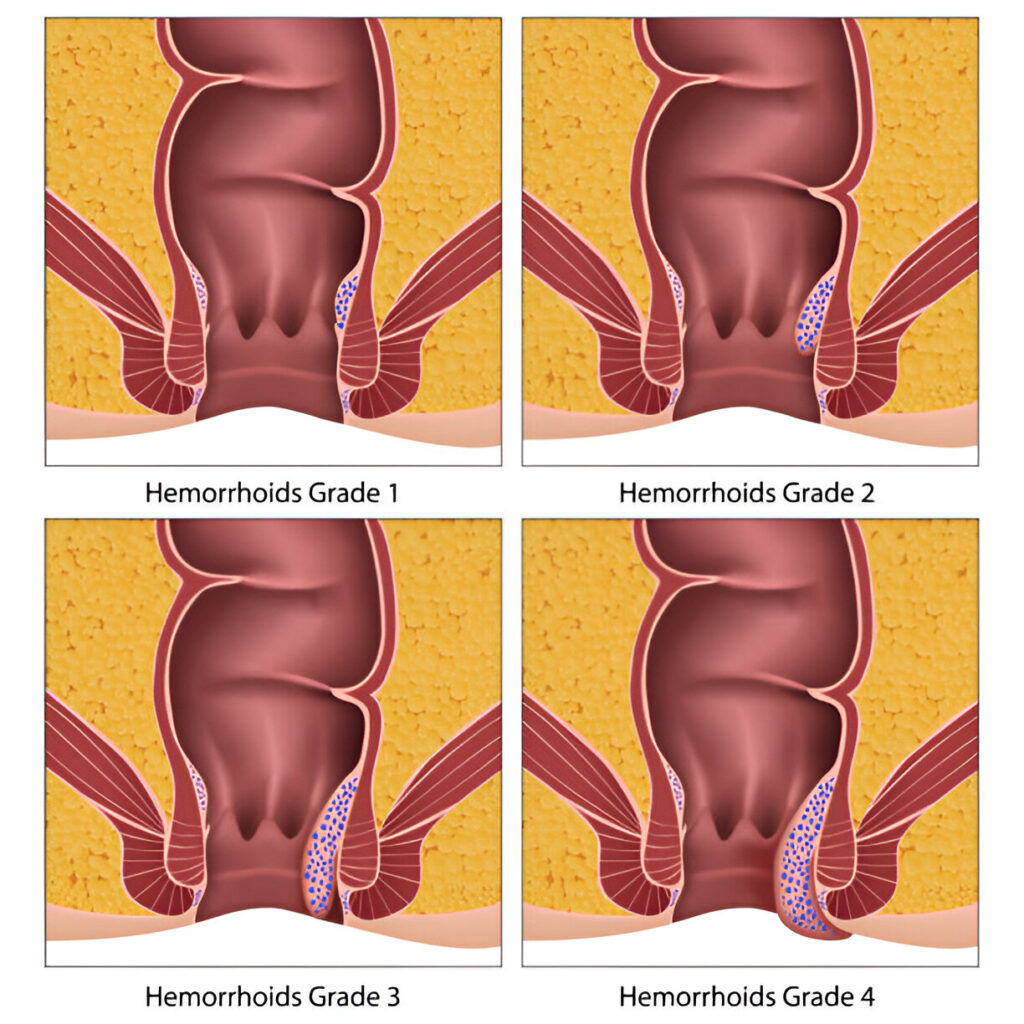 home remedies for hemorrhoids in female anus