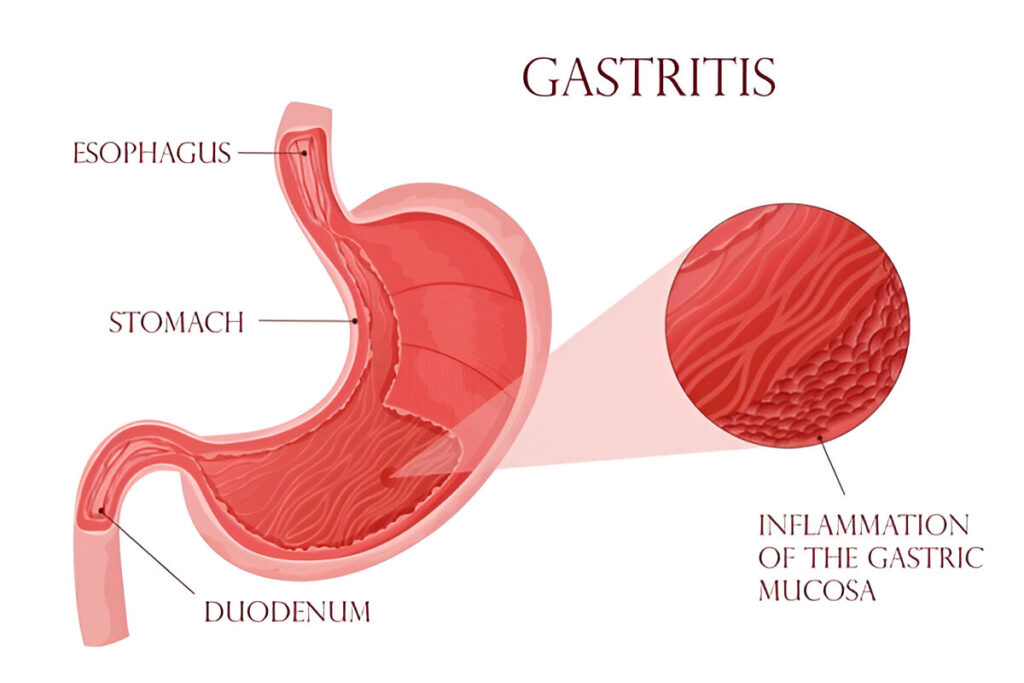 What is the best treatment for gastritis