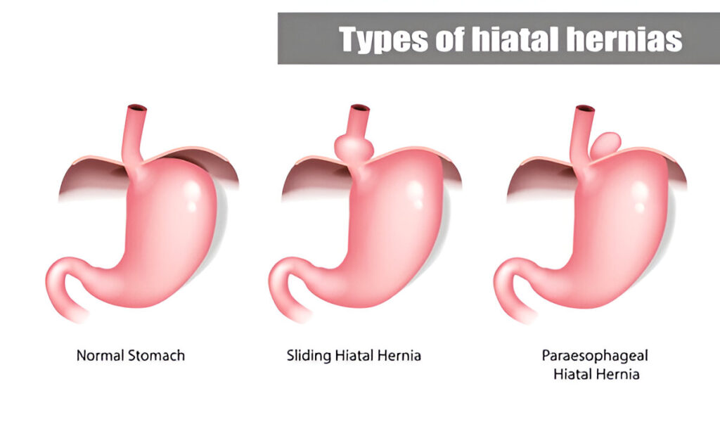 hiatal hernia back pain