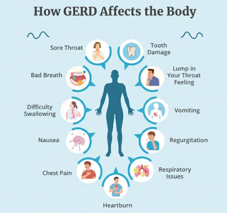 GERD Symptoms Beyond Chest Pain