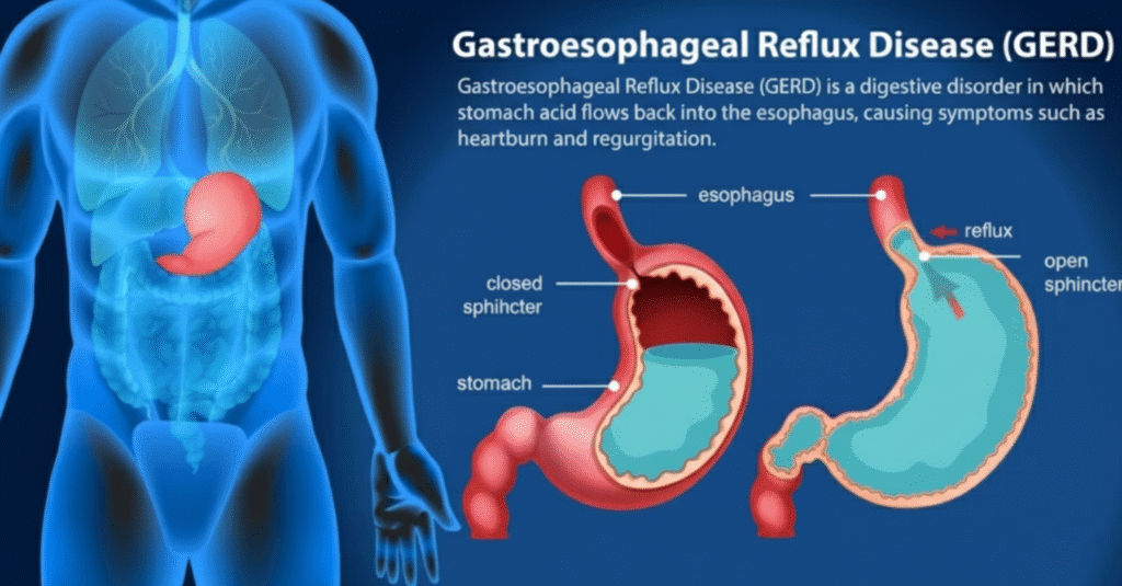 why is acid reflux worse at night