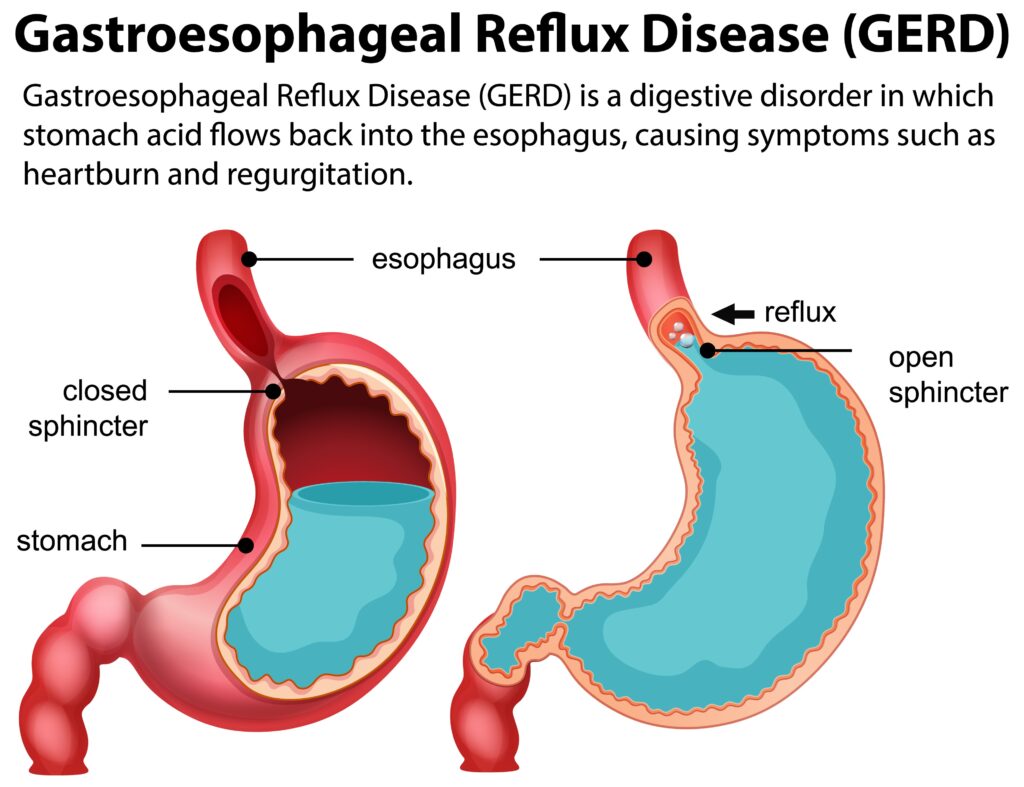 chest pain from gerd