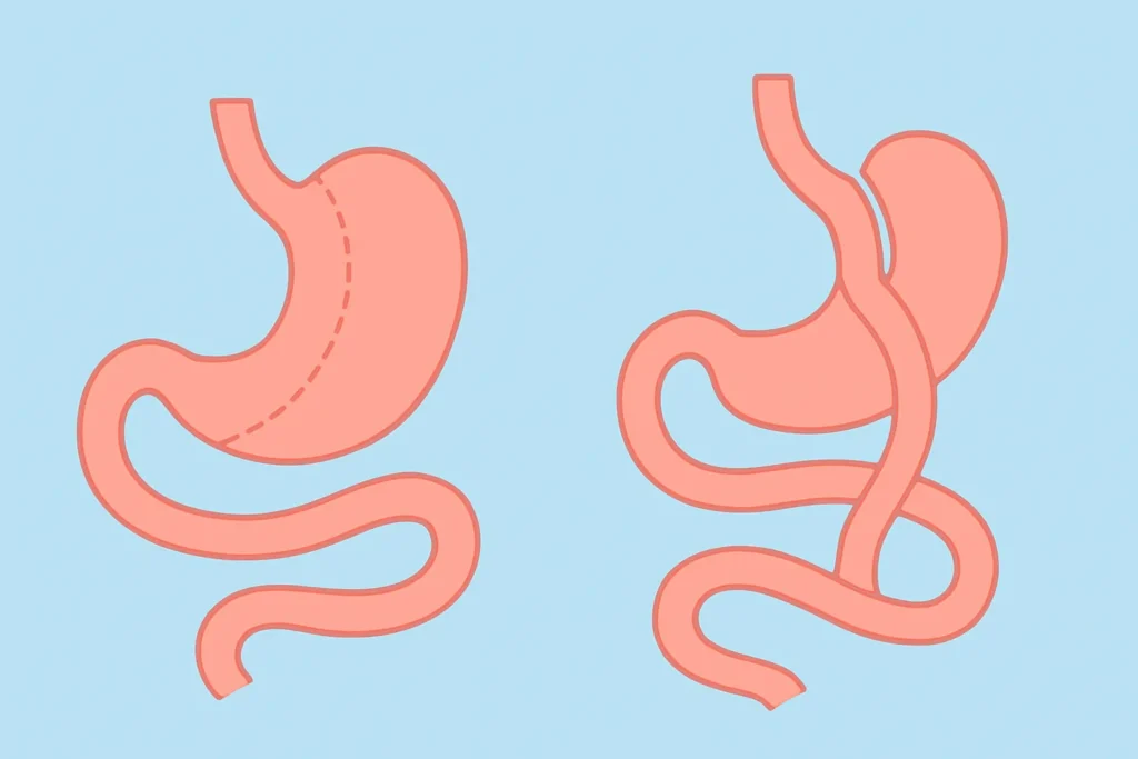 صورة توضح الفرق بين تكميم المعدة وتحويل المسار
