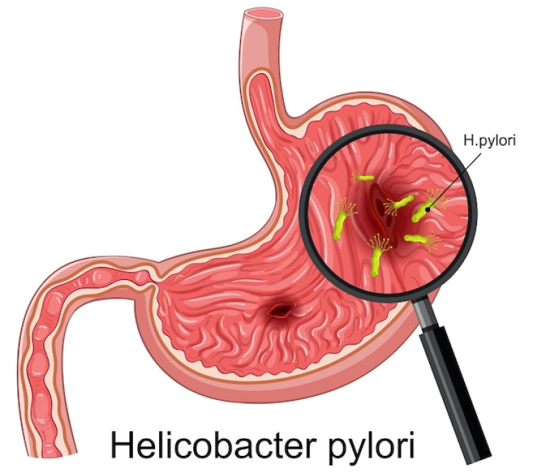h pylori test