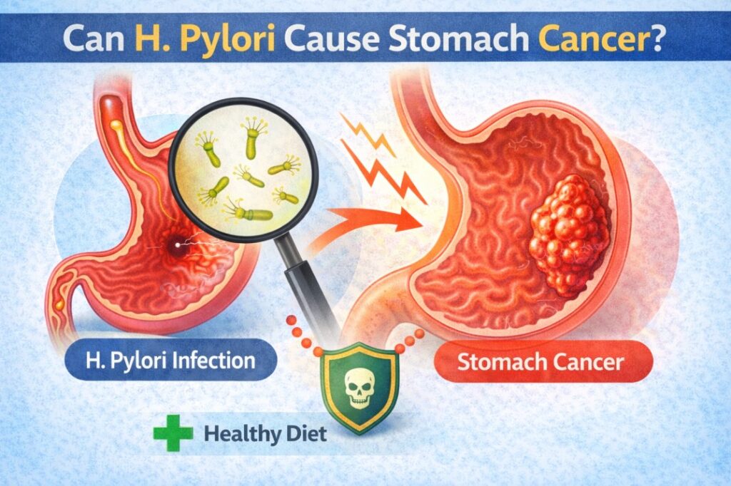 Can H. Pylori Cause Stomach Cancer