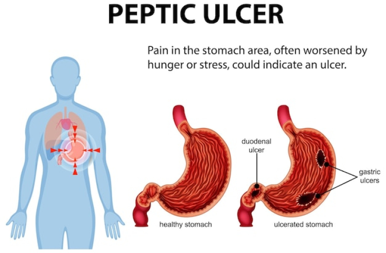 peptic ulcer disease