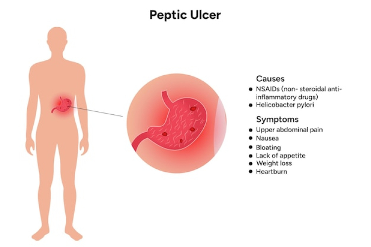 peptic ulcer symptoms