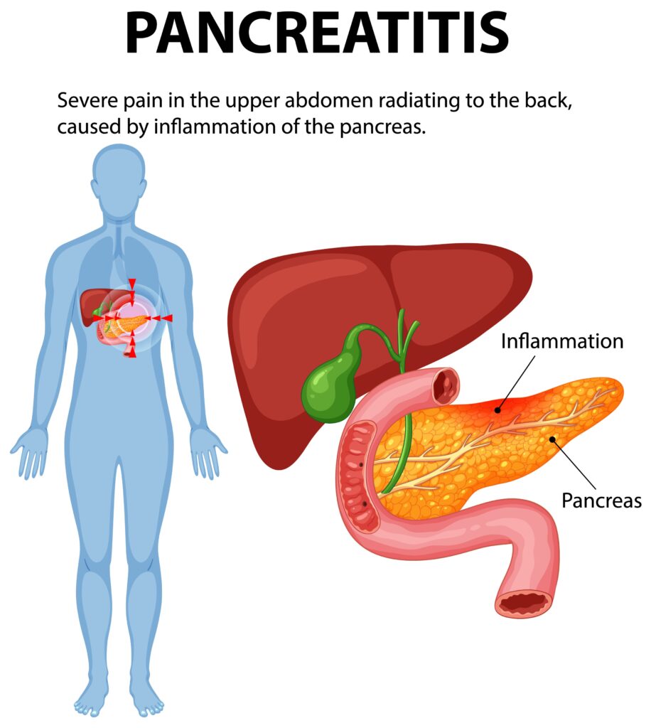 mounjaro and pancreatitis